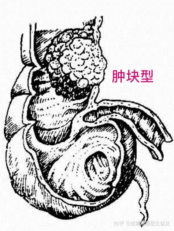 结直肠癌的病理形态分型
