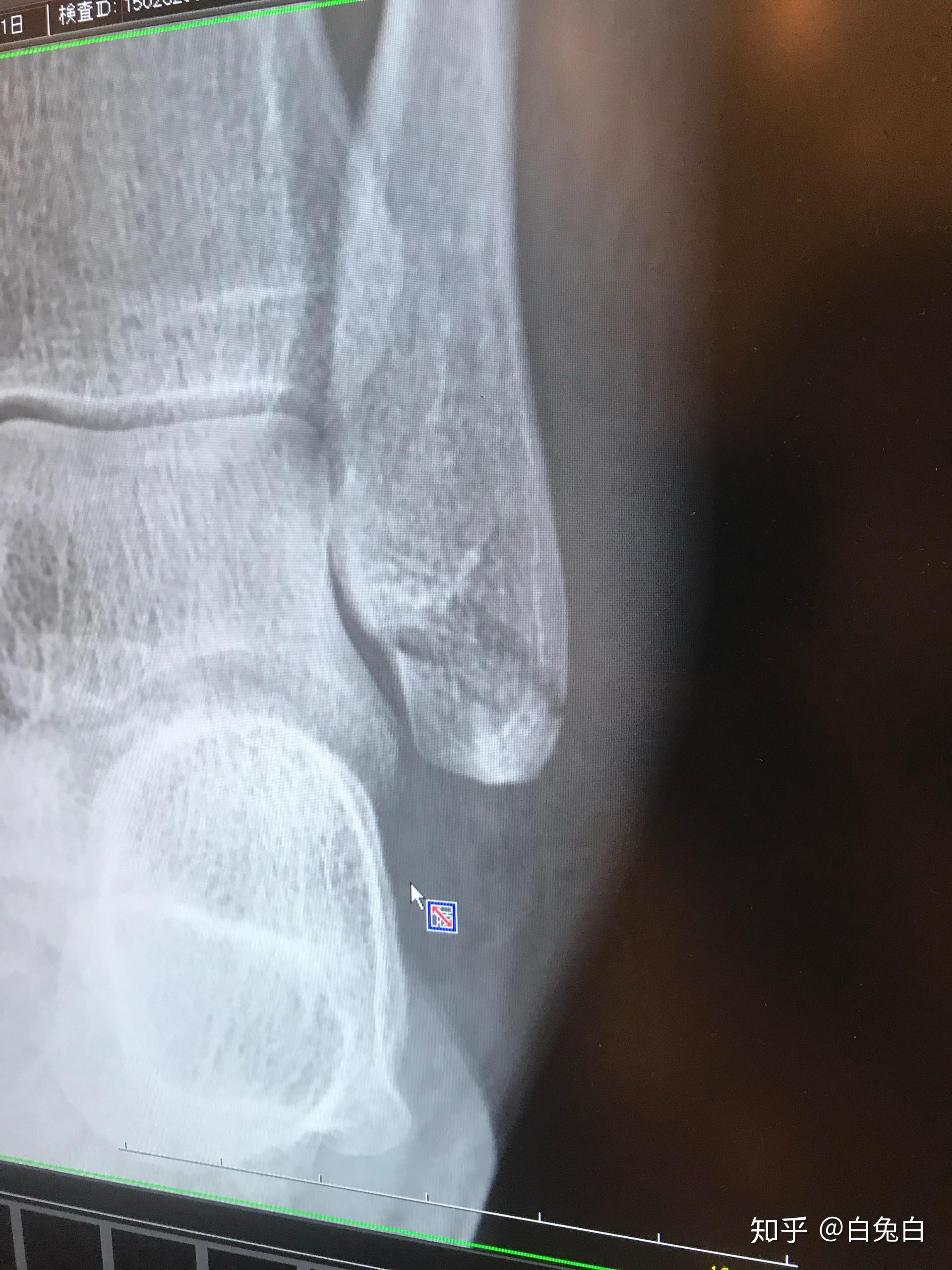左外踝脚踝撕脱骨折25天支具固定无其他不良反应_其他科室_邻医网