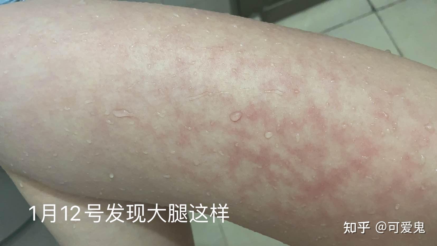 电暖风烫伤腿上起了一片像大理石纹一样的斑纹哪位同学有过同样经历