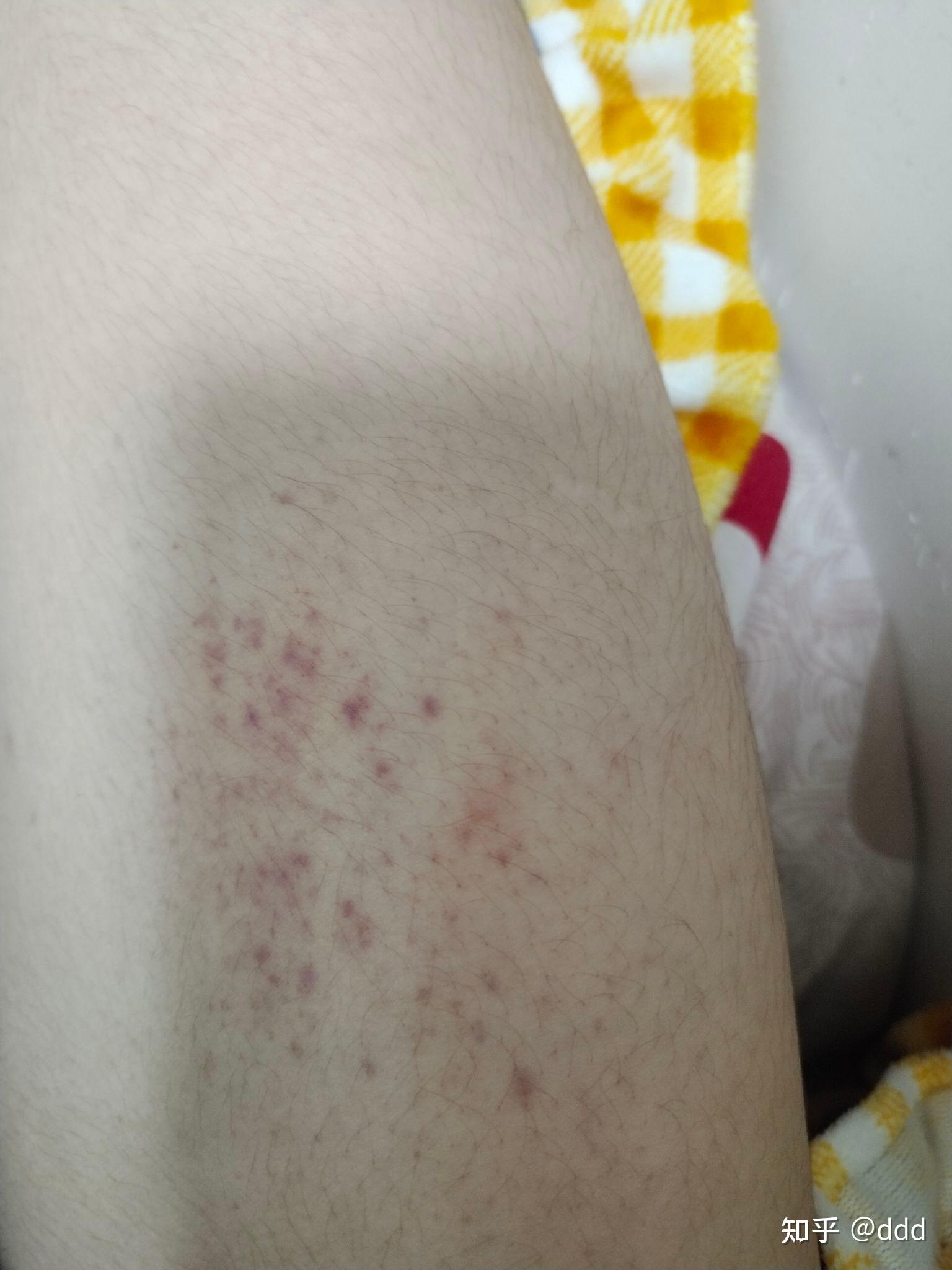 大腿内侧长了红紫色的很多小红点，像是淤血一样，不疼不痒，请问这是怎么回事？_百度知道