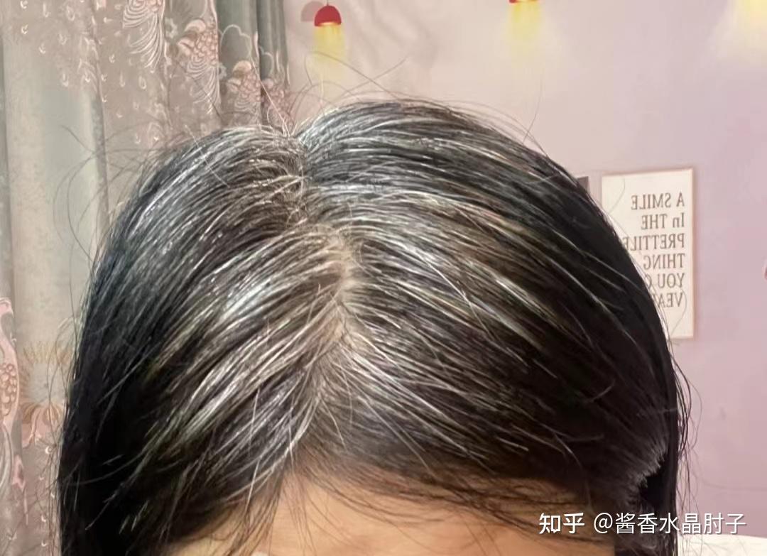 20出头白发非常严重，连新长出的发根都是白色，怎么才能改善白发啊？！ - 知乎