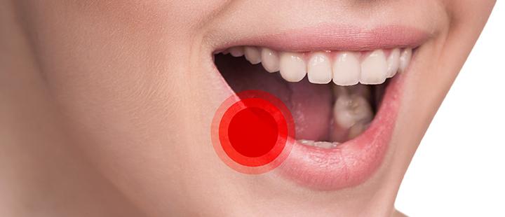 唇疱疹 Cold Sores 知乎 唇疱疹 Cold Sores 知乎