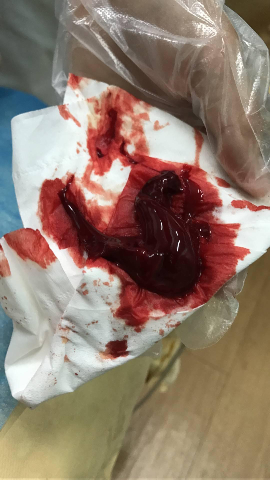 用梅花针拔气罐法从血液中出来的果冻状的东西是什么