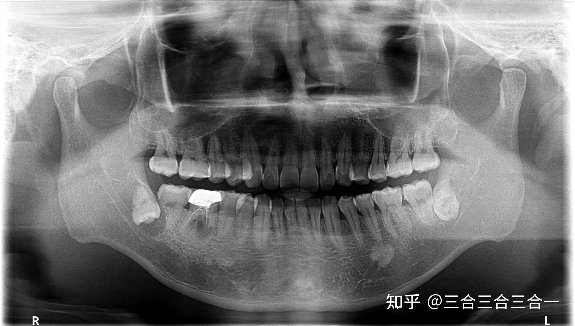 有没有牙被智齿顶歪了但是不疼的呀?
