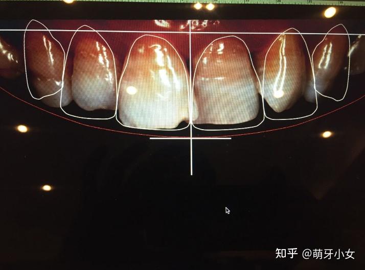 门牙可以变小点吗？ - 知乎