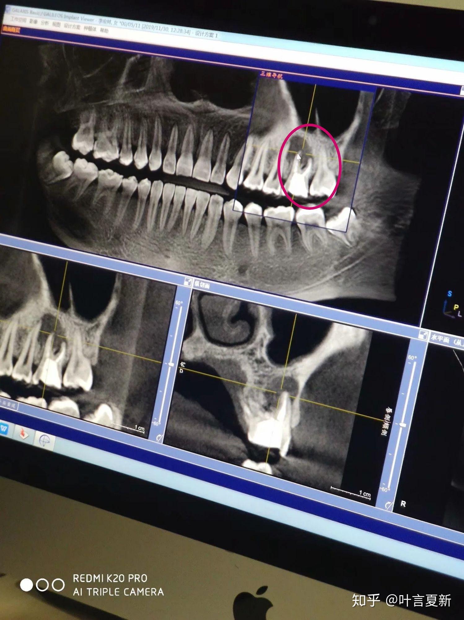 我的牙齿片子已经拍了,医生说有一个大的囊肿,请教,怎么办? - 知乎