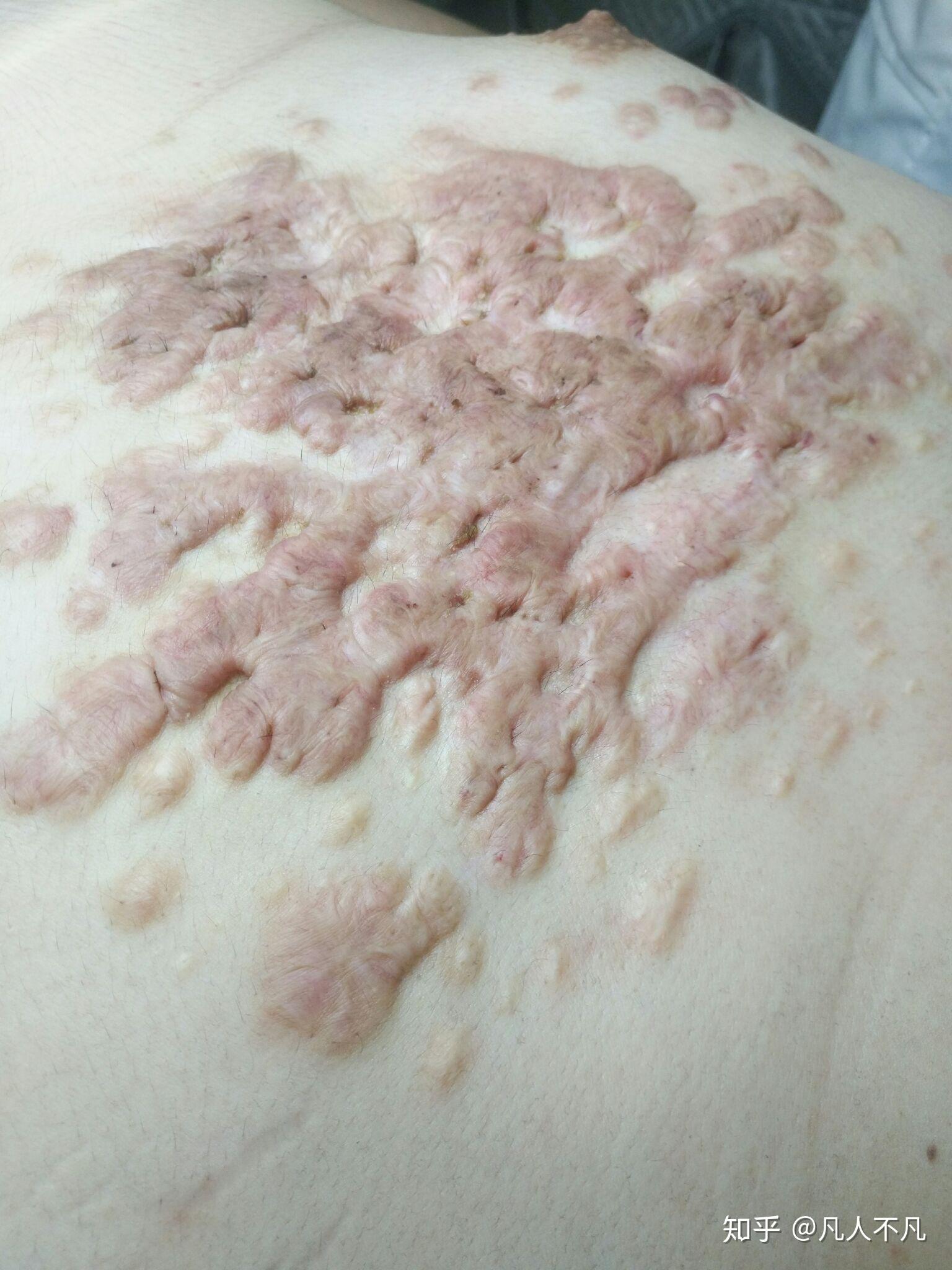 疤痕疙瘩是不是治不好