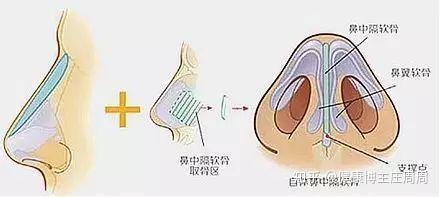 首大吴园丁 鼻中隔或鼻腔内软骨暴露要做哪些检查 知乎