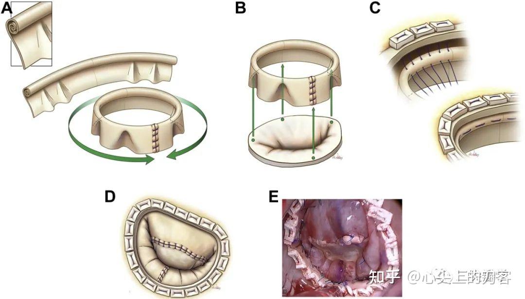二尖瓣 成形术图片