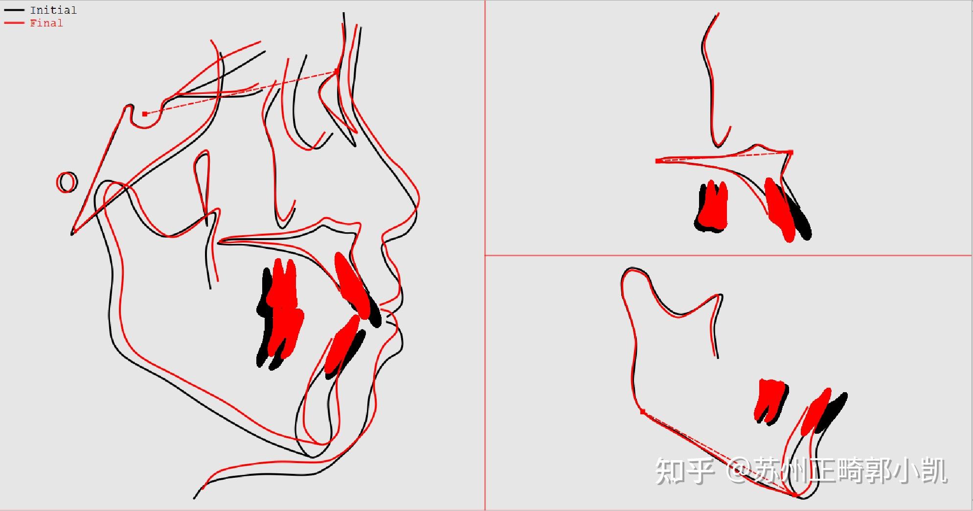 直面型达成√√√重叠图也可以看到下颌骨有轻度逆时针旋转,下巴逆旋"