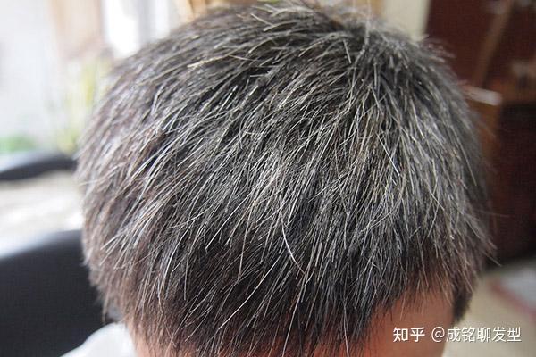 年纪轻轻就满头白发,显老又没气质,有什么方法可以减少长白发? - 知乎
