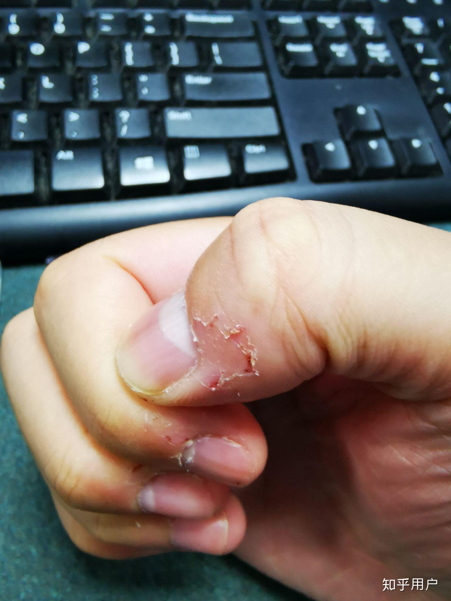 咬手皮是一种怎样的心理? - 知乎