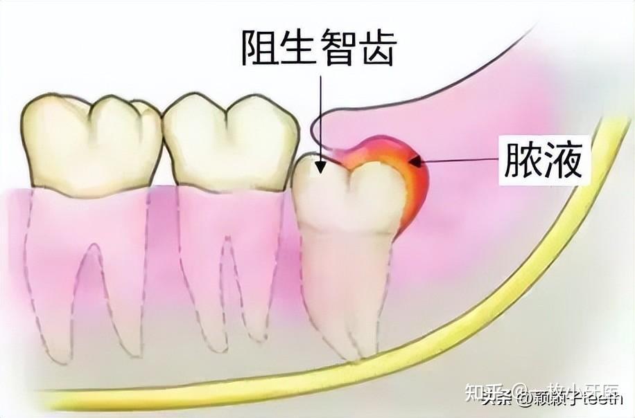 得了智齿冠周炎，疼得受不了怎么办？ - 知乎