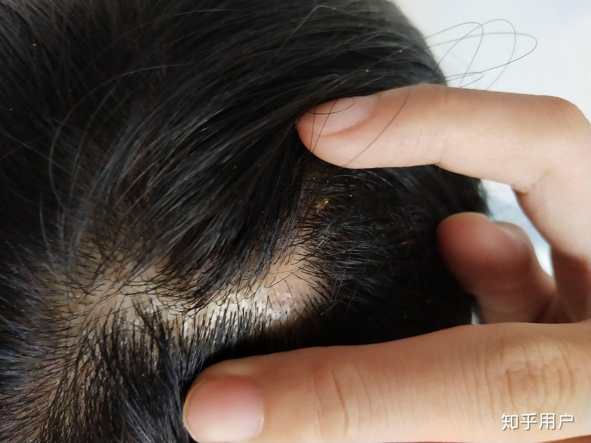 头皮长了个疤,结痂了,不长头发了,医院看了也没用,求高人指点下用什么