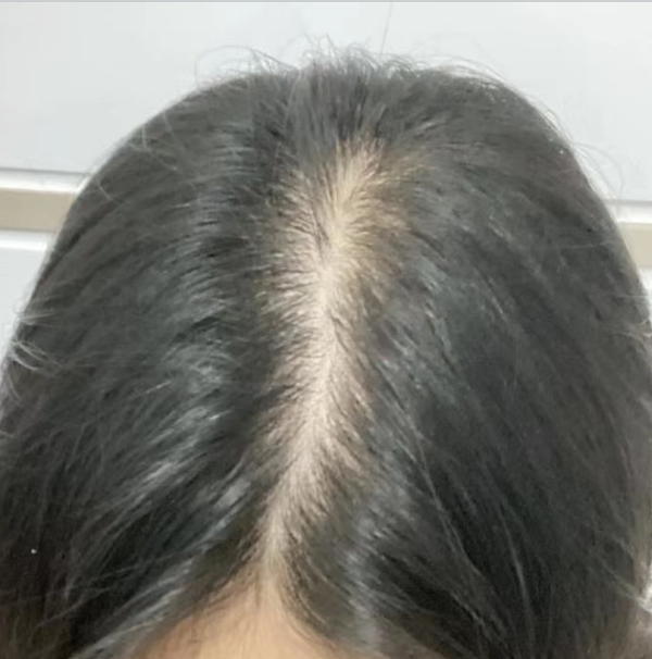 女生 发量少 头顶快秃了 有没有什么好的生发方法!跪求!