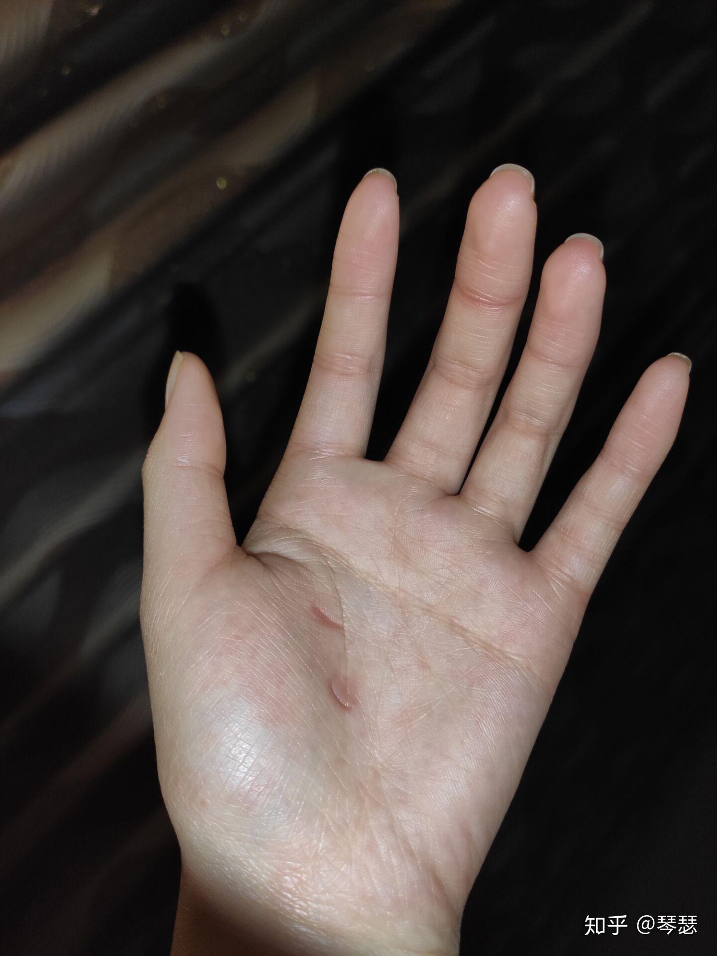 睡觉中经常会紧握住手成拳头状,醒后发现指甲掐的手心很深的印是怎么