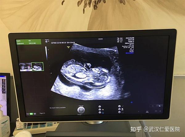 四维彩超"幸好在孕12周就发现了问题,可以及时终止妊娠.