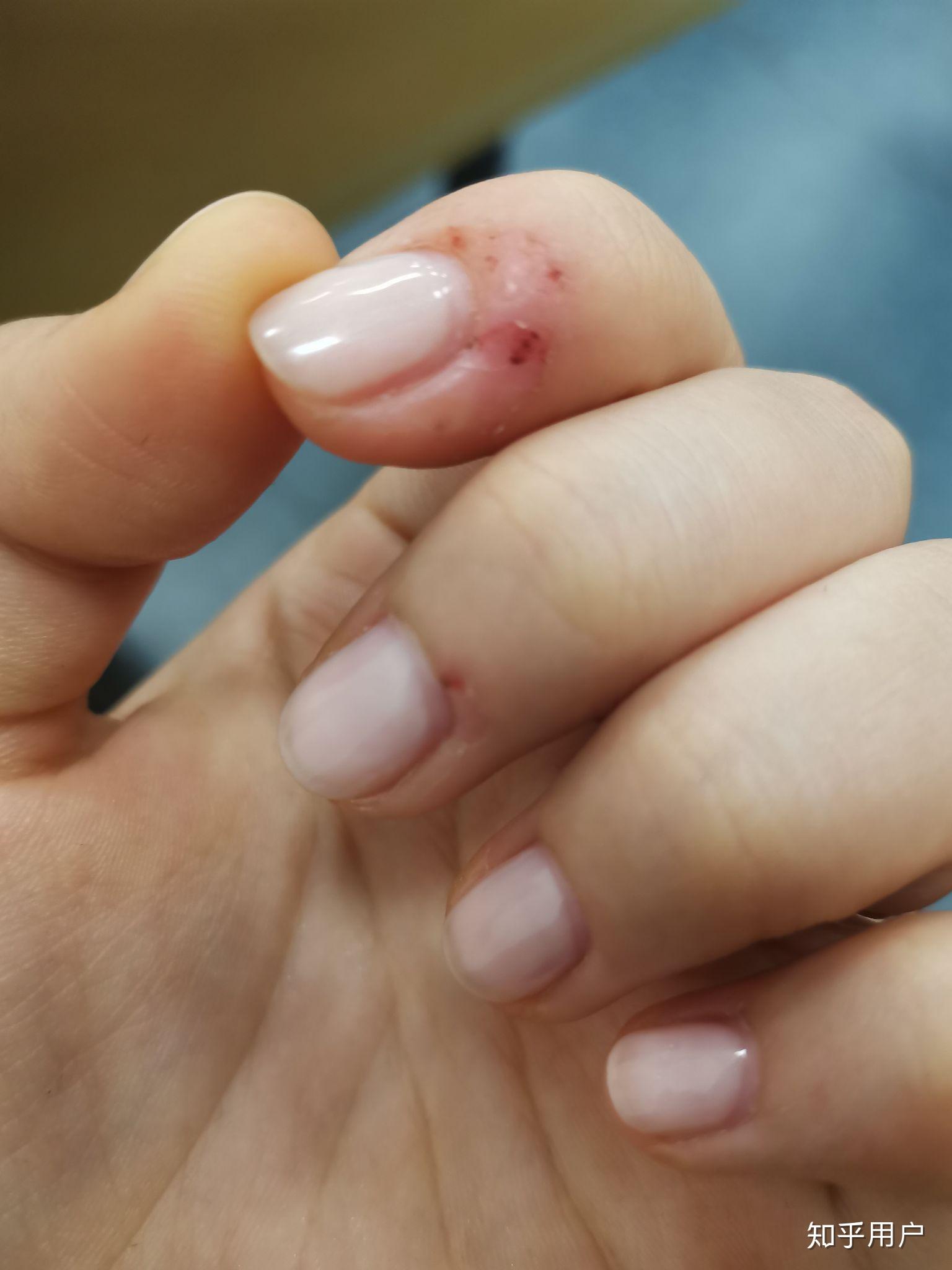 咬手皮是一种怎样的心理? - 知乎
