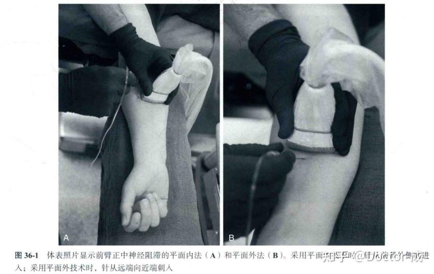 笔记-正中神经阻滞 - 知乎