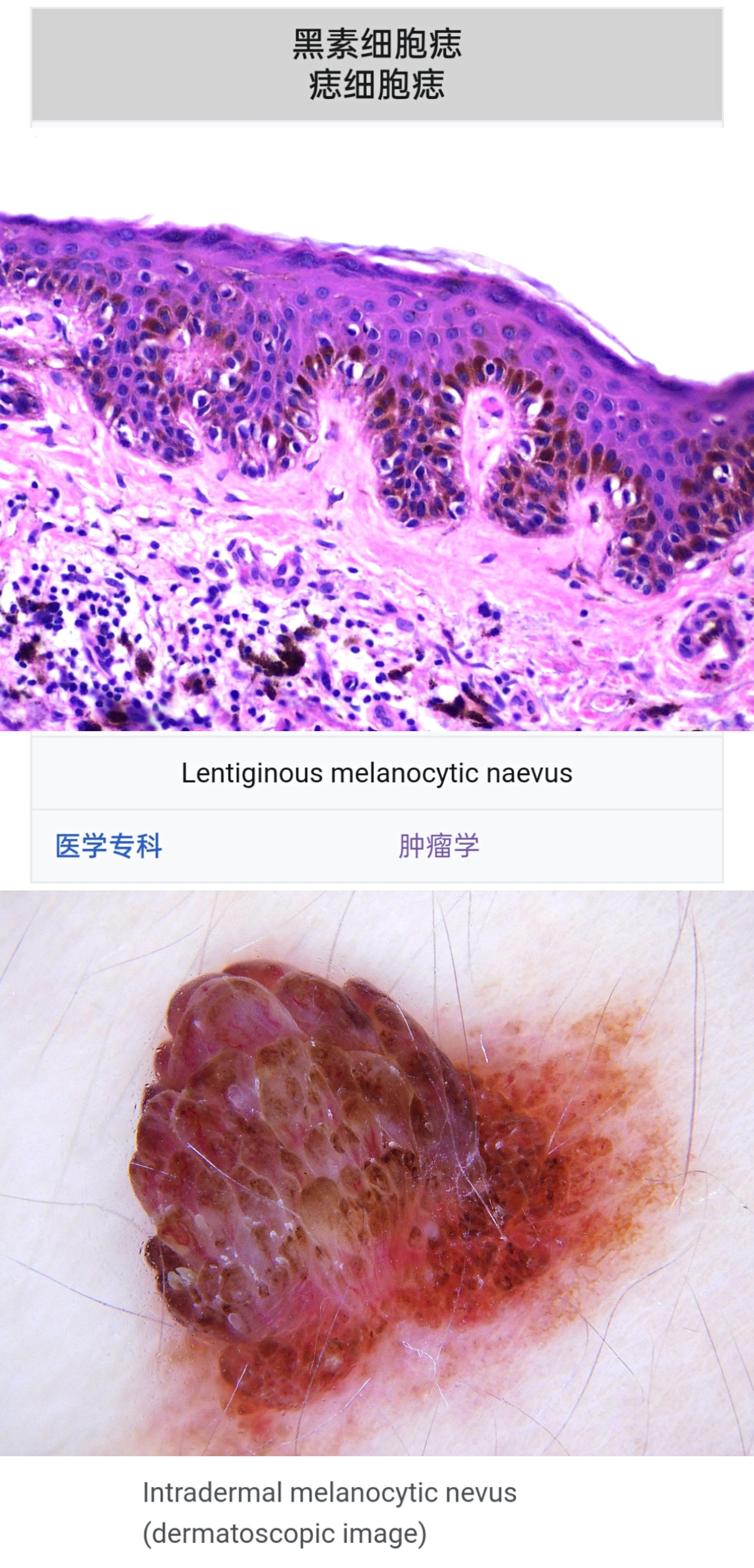 喉癌/淋巴系统/远端转移/良性肿瘤/p53/自噬 - 知乎