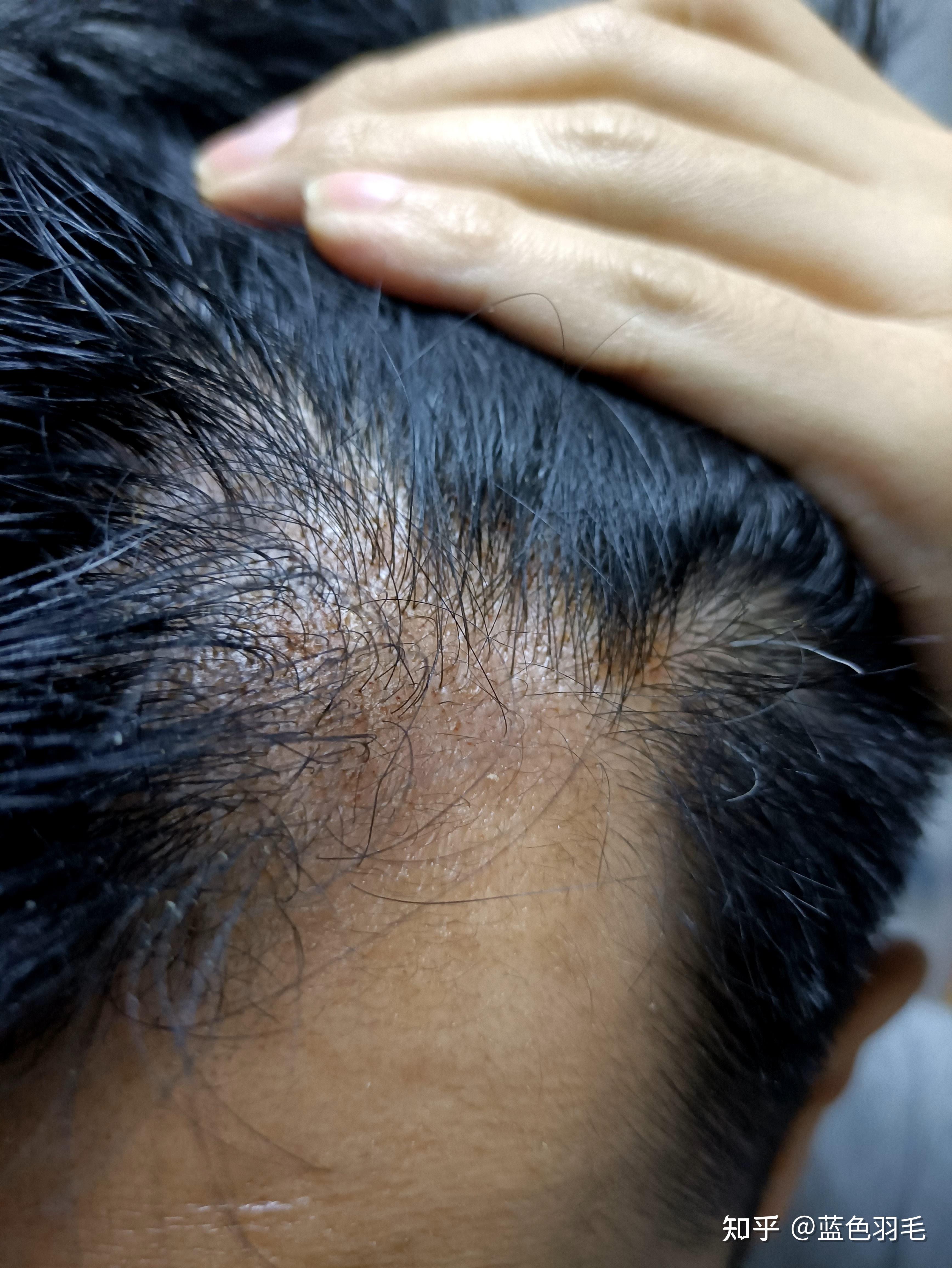 滚轮微针治疗脱发全程记录更新至202256