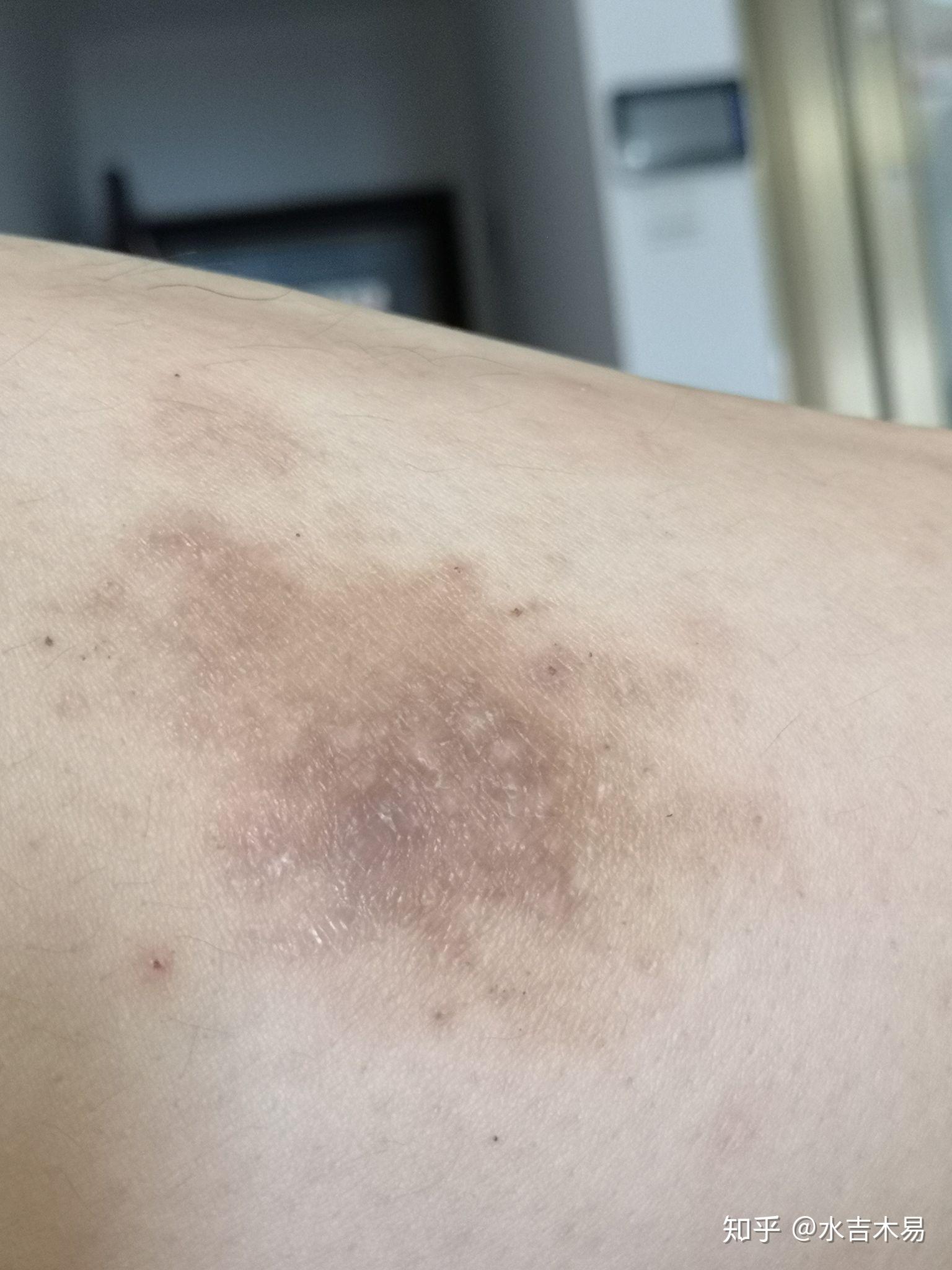 成年人湿疹两年看了医生还是反复发作?