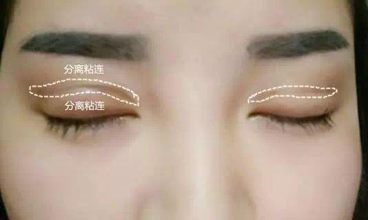 手术导致的腱膜组织缝合修复(肌力修复)第四步,分离重睑线下方的皮肤