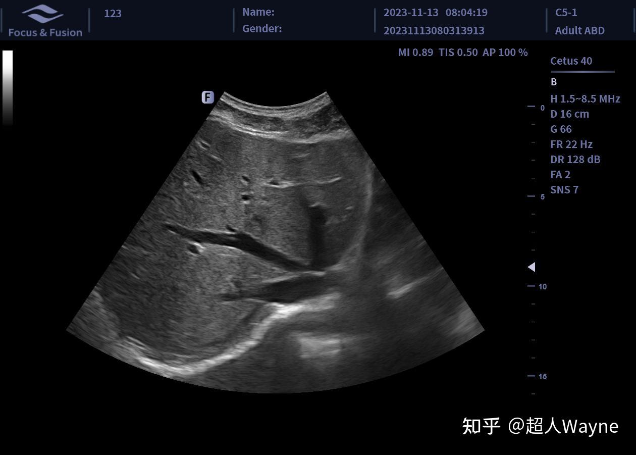 肝右叶超声图图片