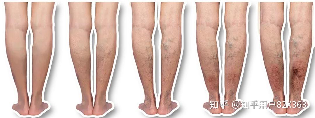 静脉曲张为什么会形成老烂腿