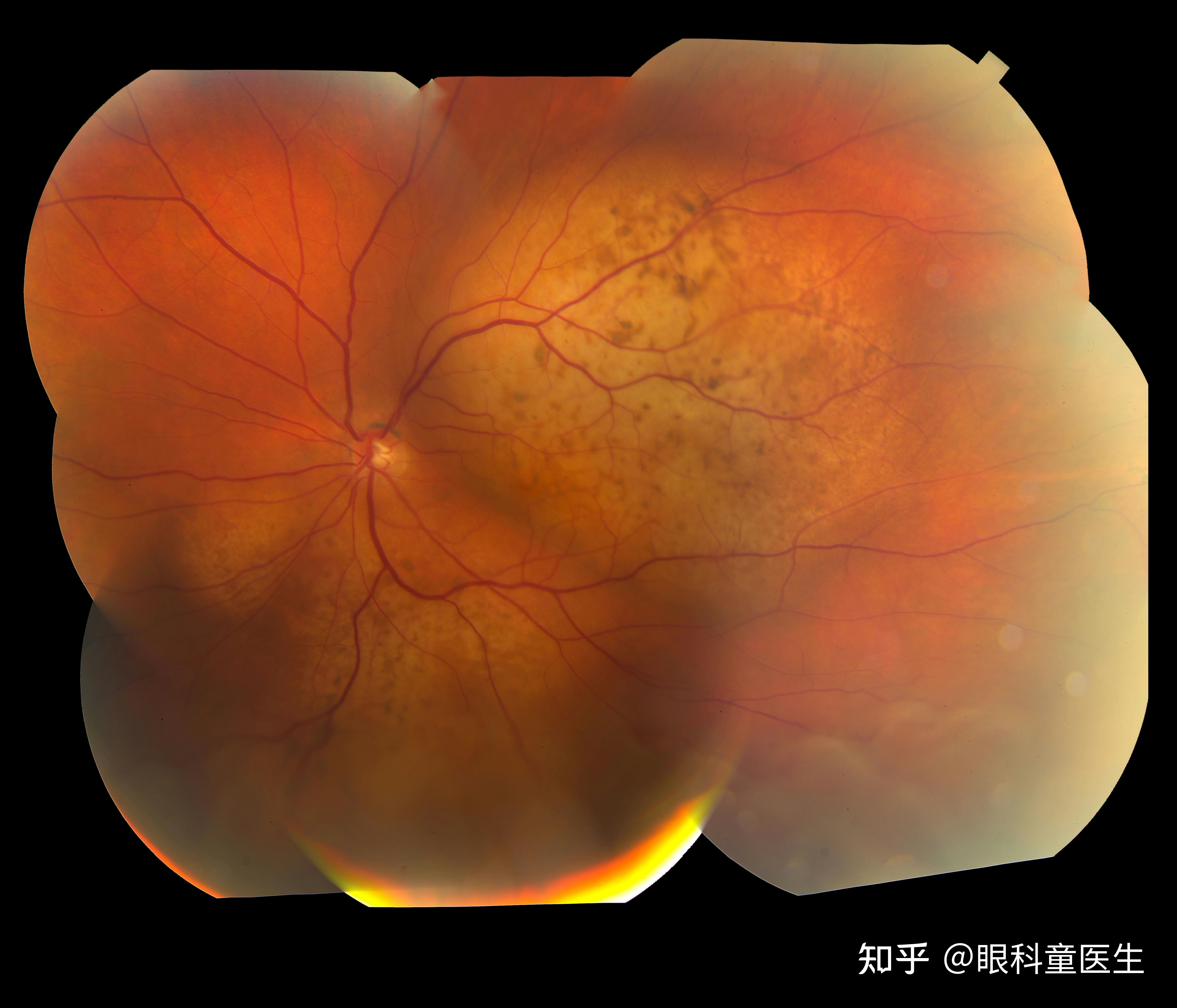 【奔走相告】葡萄膜炎与眼免疫疾病中心在我院成立_治疗
