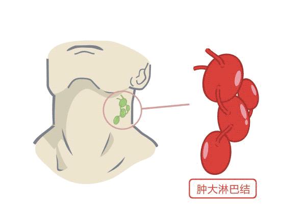 出现淋巴结肿大是癌症发生转移了吗