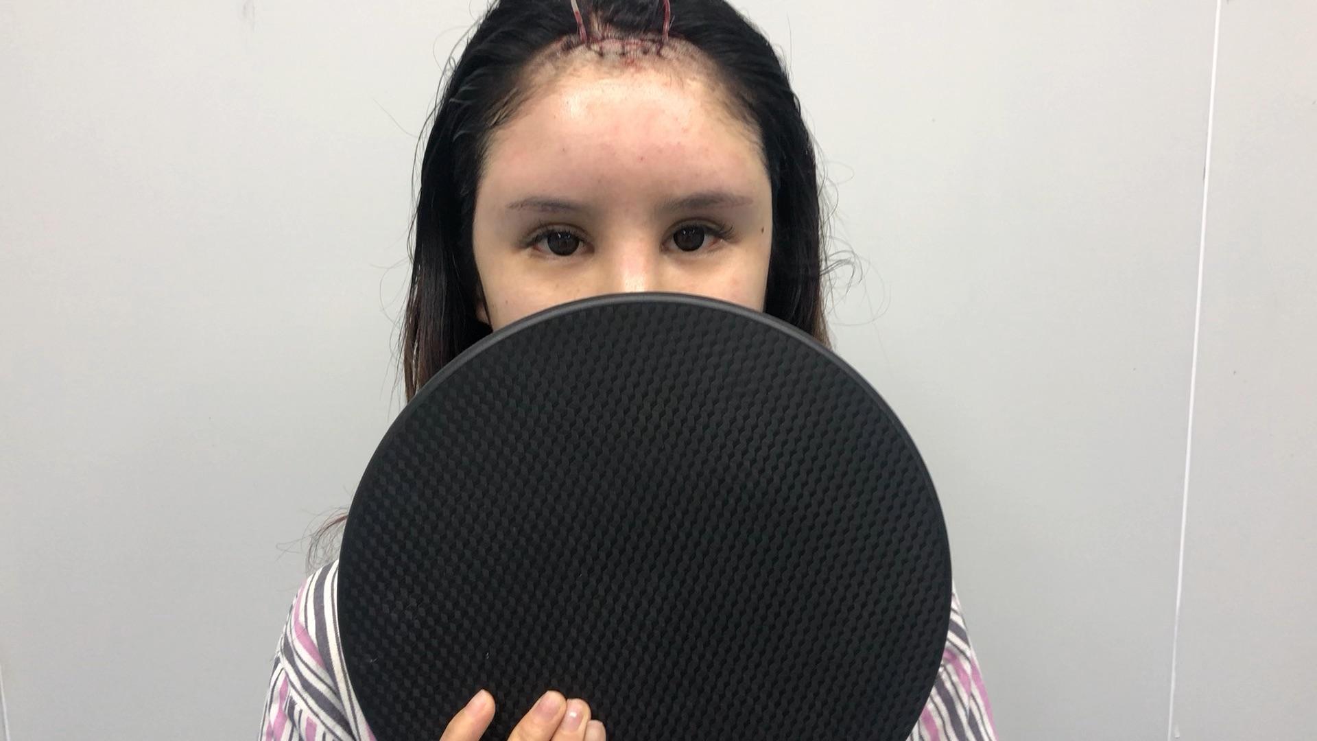 额头假体现场确认