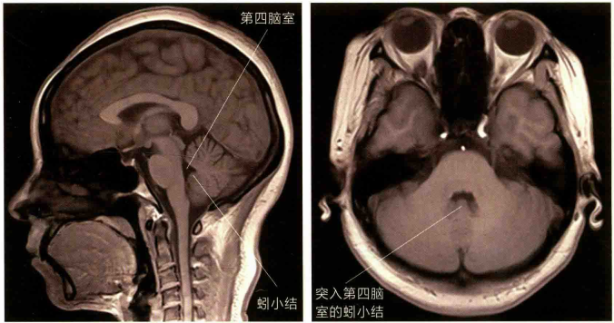 小脑蚓部影像解剖图片