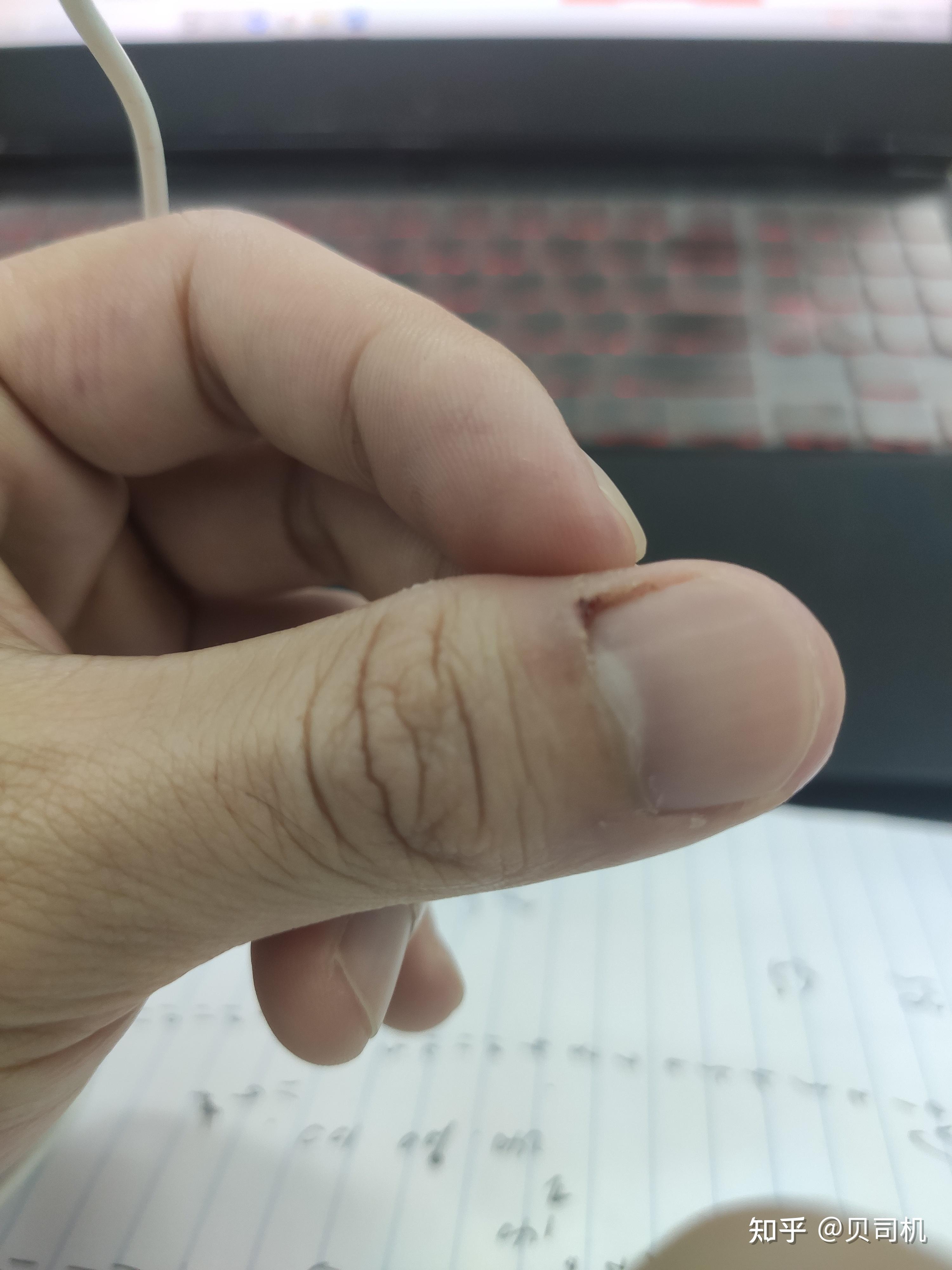 指甲盖一按就疼 知乎