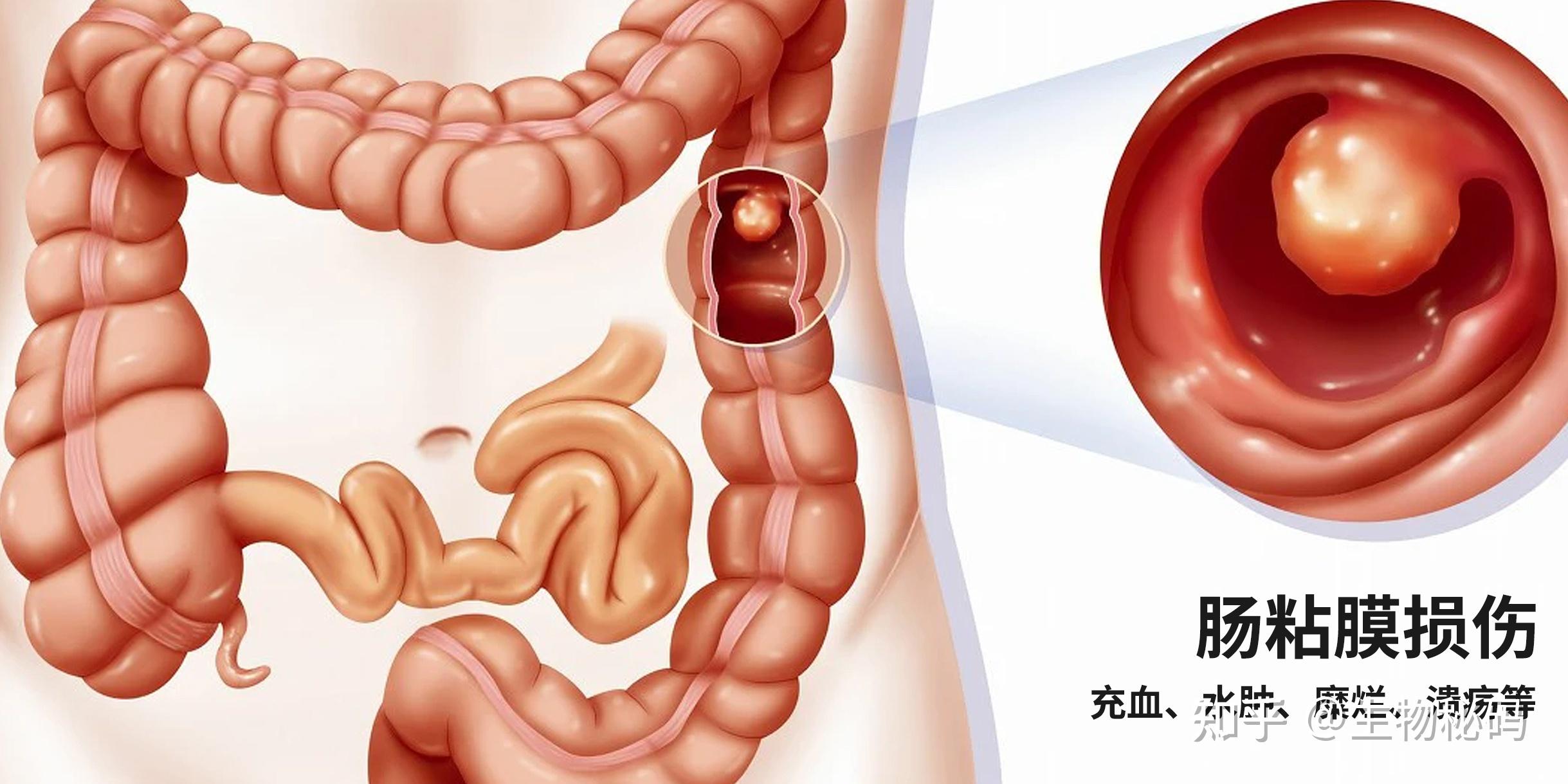 腸道不好就吃益生菌小心黏膜屏障不完整越吃腸道損傷越狠