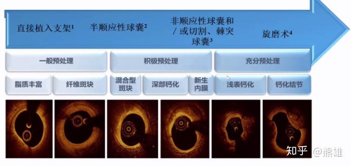 纤维成分较多,则要积极预处理,考虑非顺应性球囊或者切割/棘突球囊