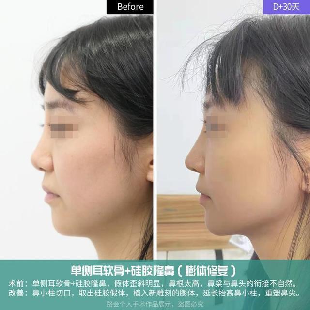 鼻梁假、山根高,膨体鼻修复3个小时变“青春少女”,手术「真实细节」分享! - 知乎