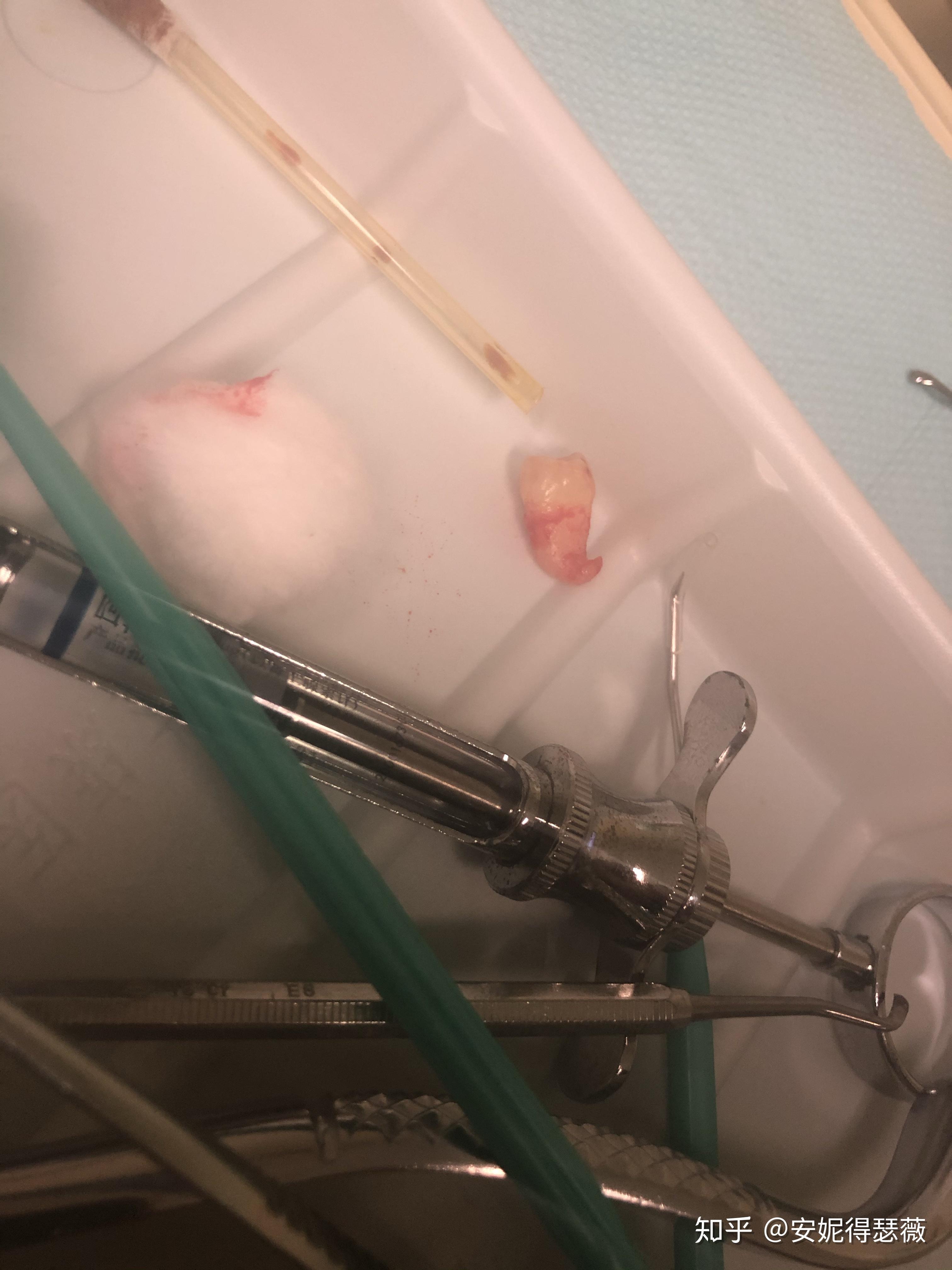 智齿牙根弯曲成鱼钩状能不能拔