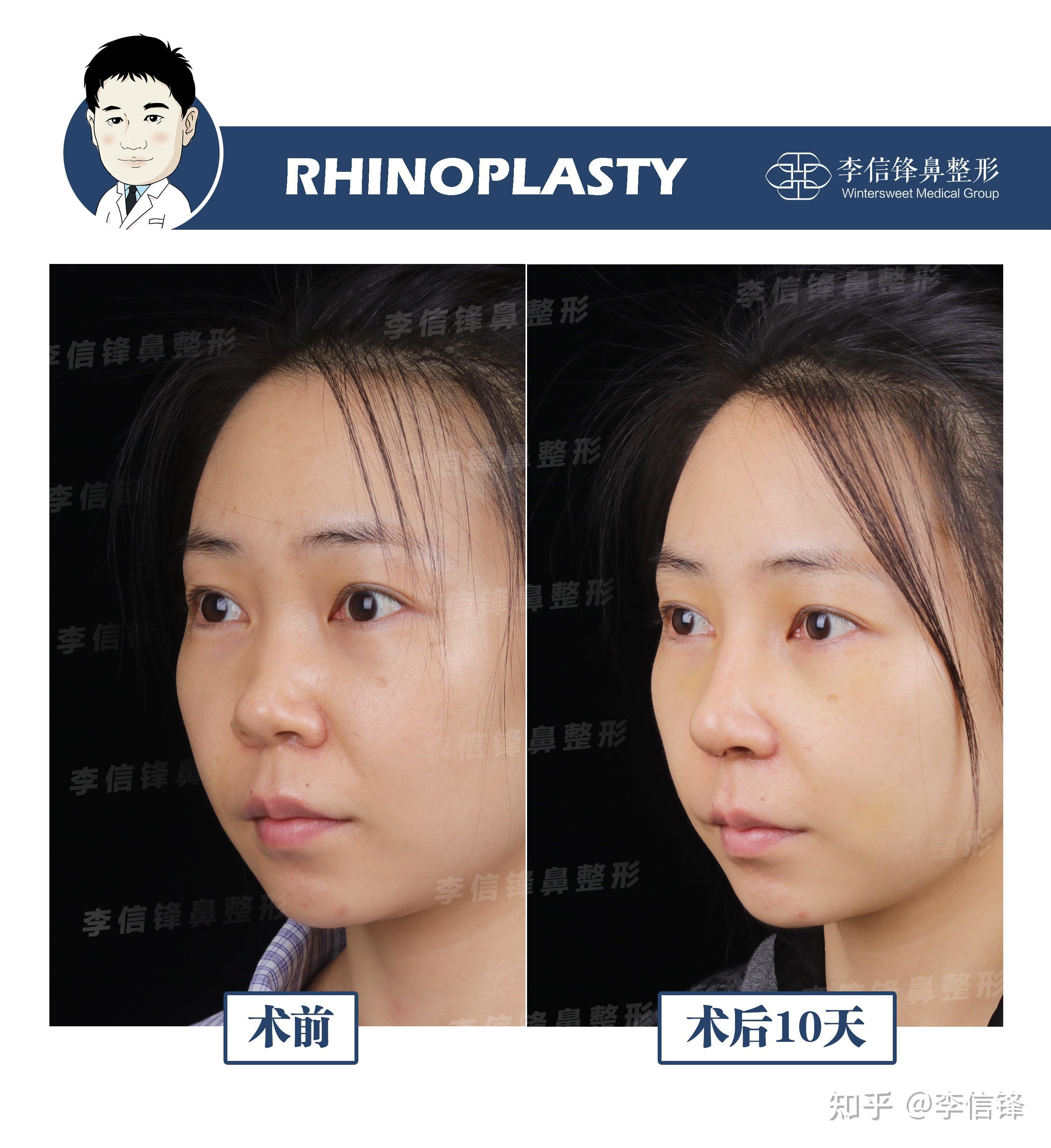 初鼻-蒜头鼻综合案例,术后十天~深圳李信锋隆鼻整形案例分享