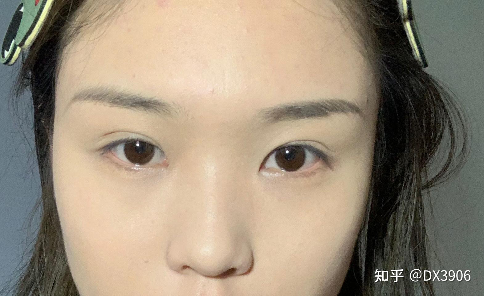 天生眼窝凹陷,做了全切双眼皮.术后六个月出现三眼皮.