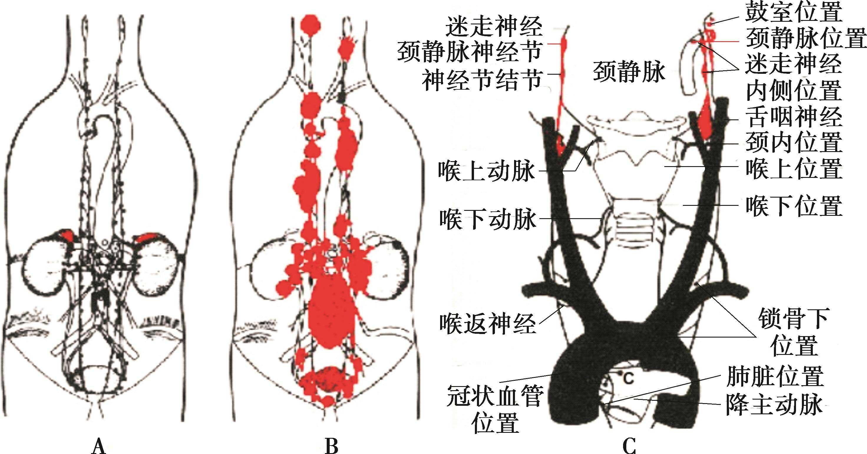 圖 1 副神經節系統腎上腺嗜鉻細胞瘤的位置(左),腎上腺外嗜鉻細胞瘤