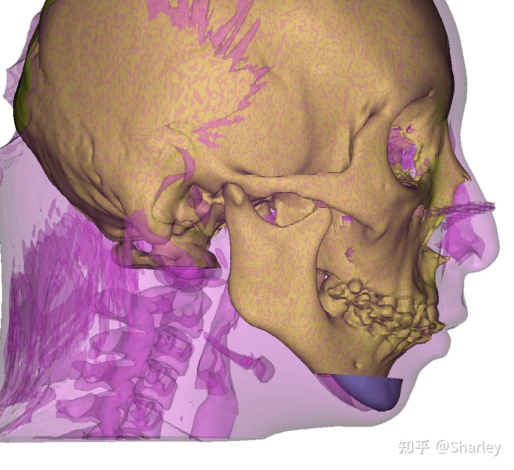 颏成型术后分享