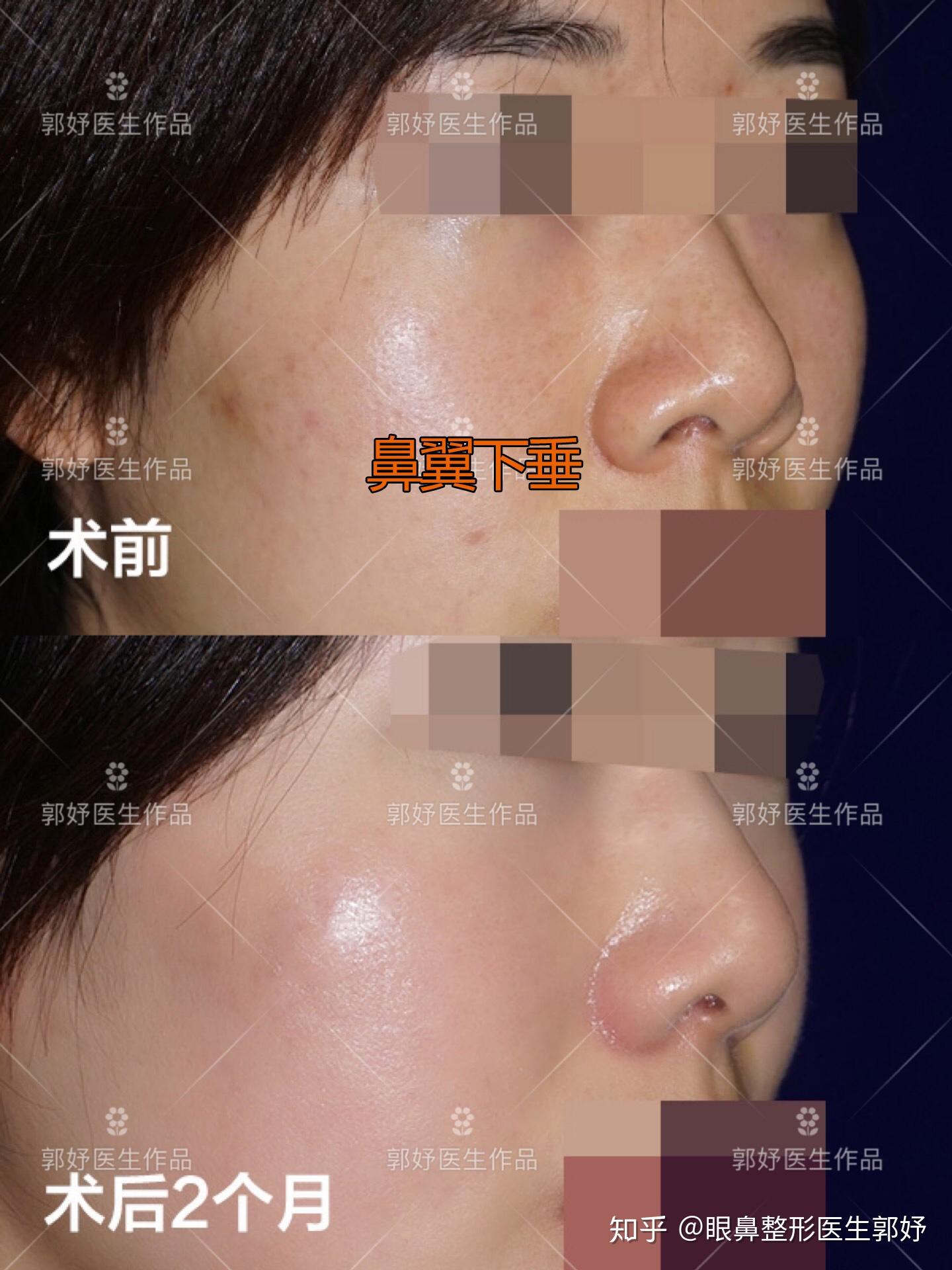 我这是朝天鼻,怎么办? - 知乎