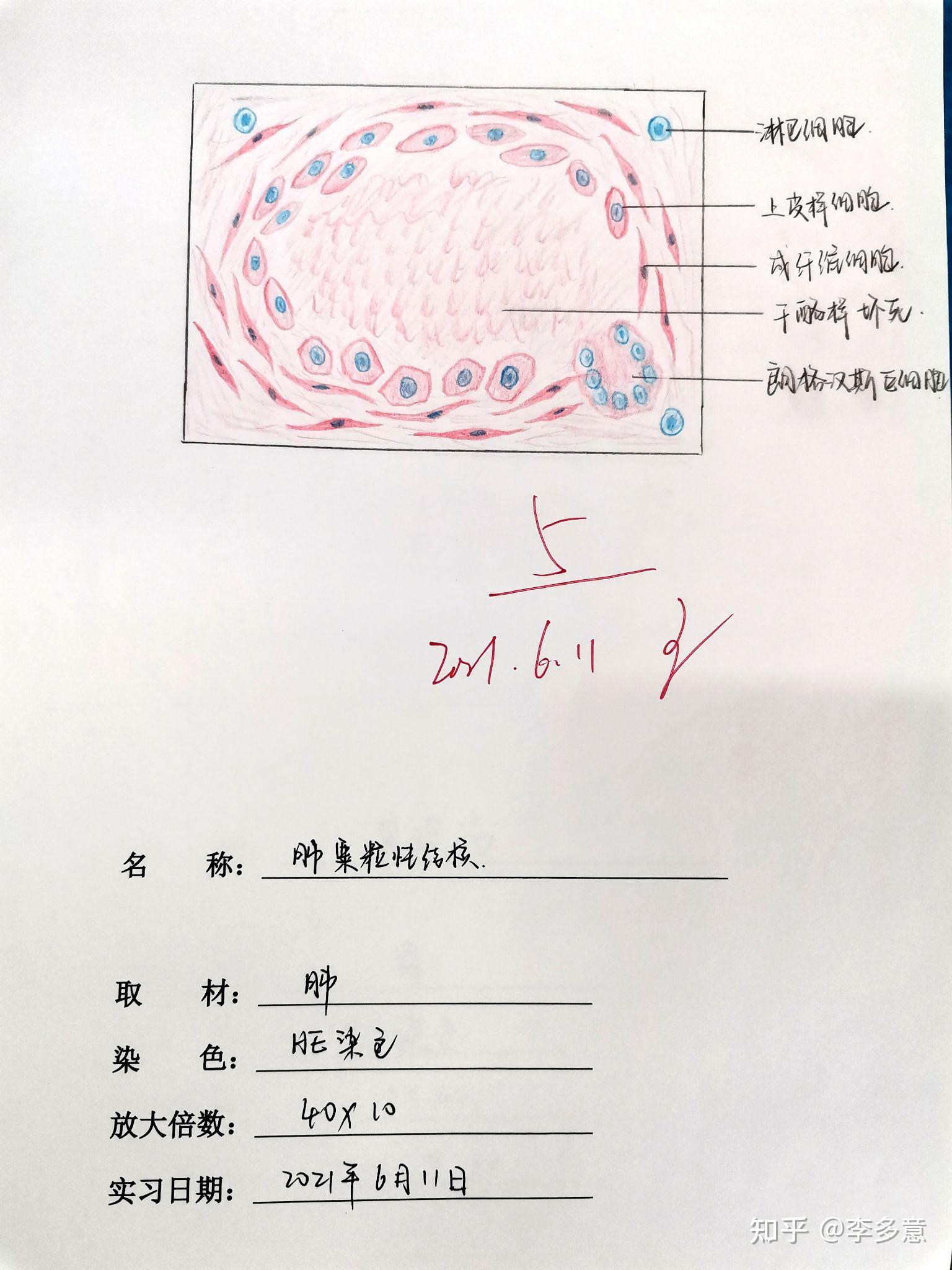 肝脂肪變性蜂窩織炎鱗狀細胞癌慢性肺淤血風溼性心肌炎大葉性肺炎肺粟