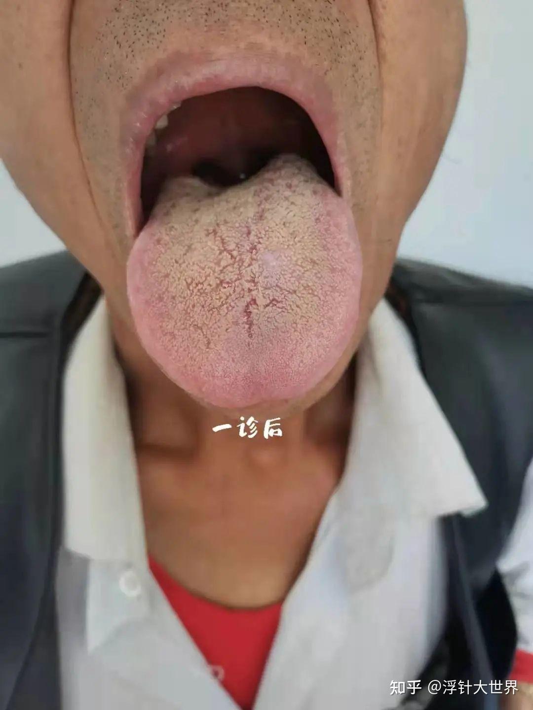 舌苔图片诊症图片