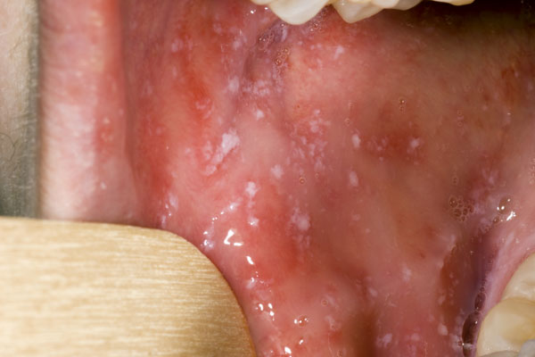 口腔麻疹粘膜斑图片