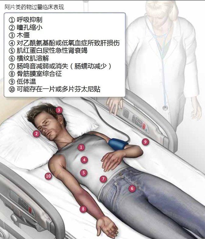 在即用型鼻喷雾剂中,kloxxadotm每剂喷雾剂中纳洛酮的含量是narcan鼻