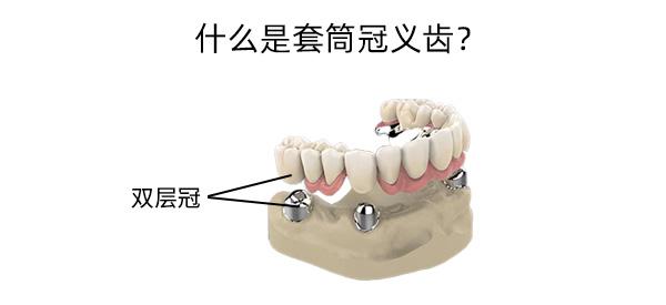 牙齿缺失修复——套筒冠义齿!