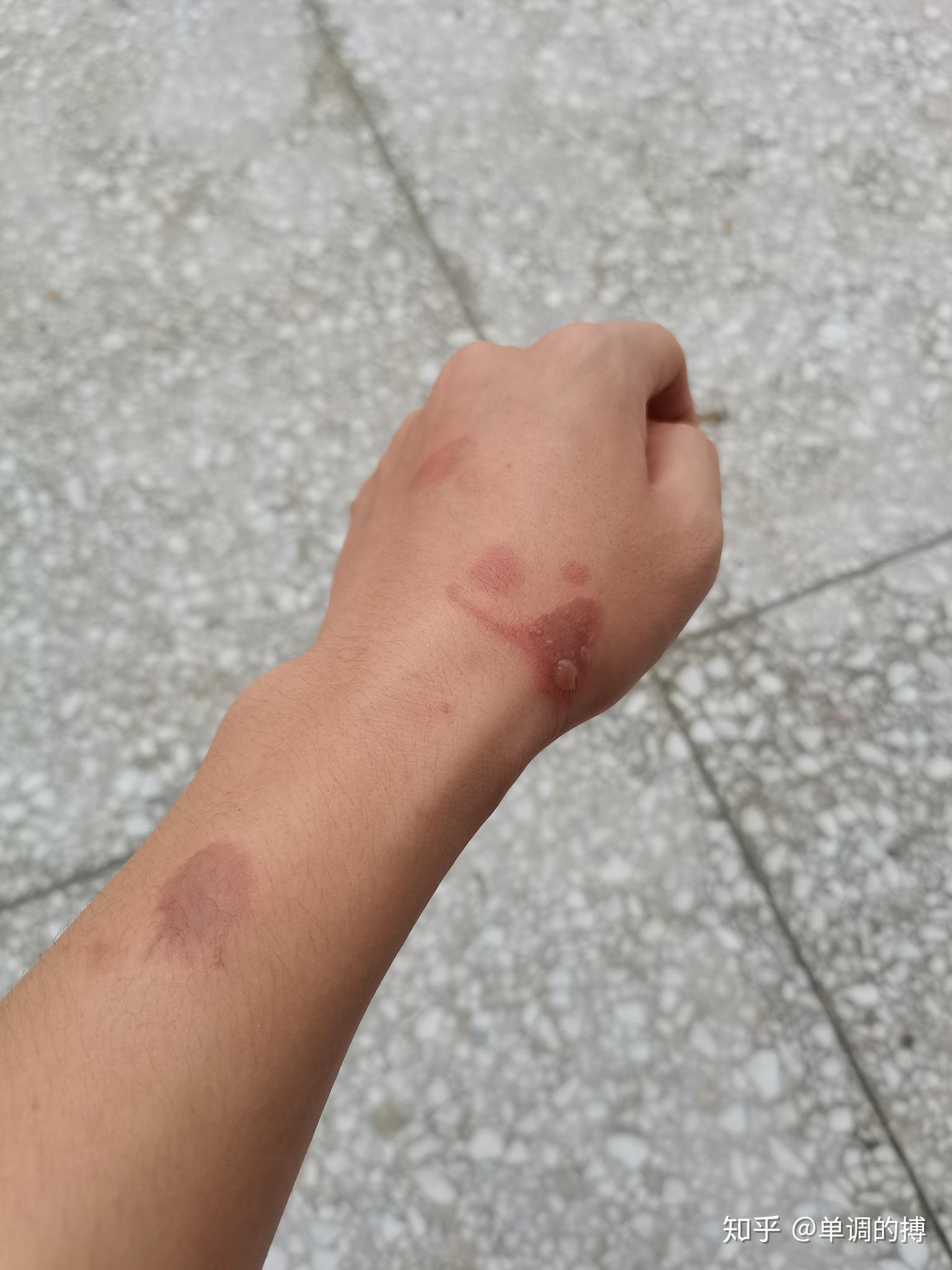 被油烫伤了怎么处理?