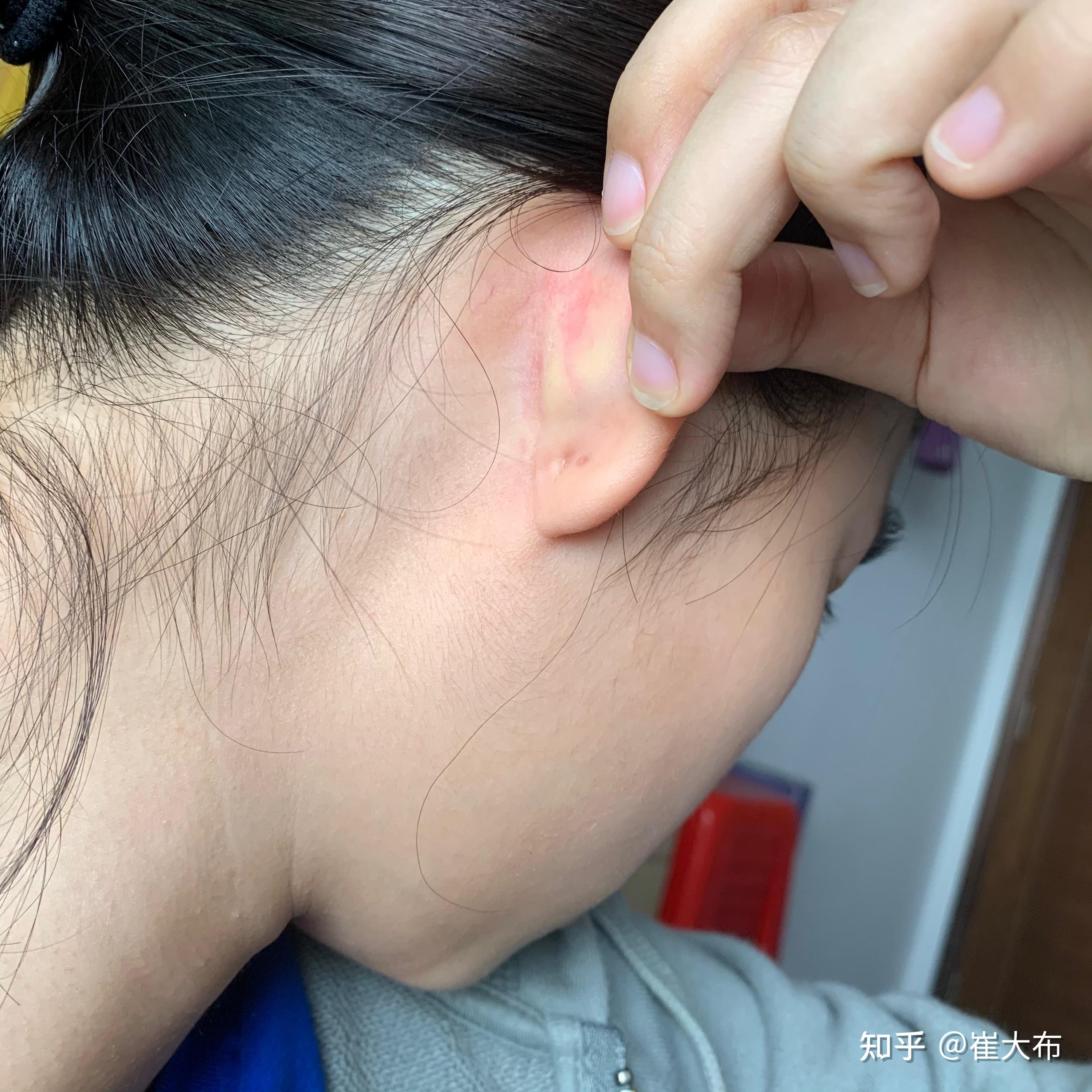 厚耳垂打耳洞是一种什么样的体验会很疼吗